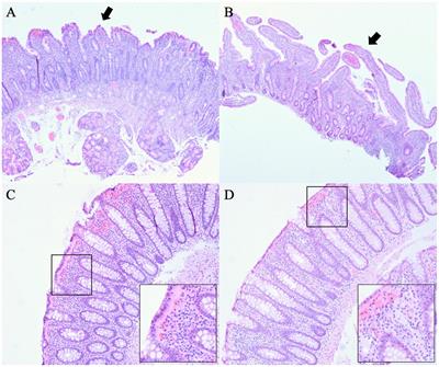 Case report: Exploring teduglutide as a therapeutic option for refractory microscopic colitis: insights and implications